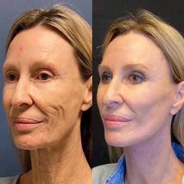 Botox Ansiktsserum AuroraNorge